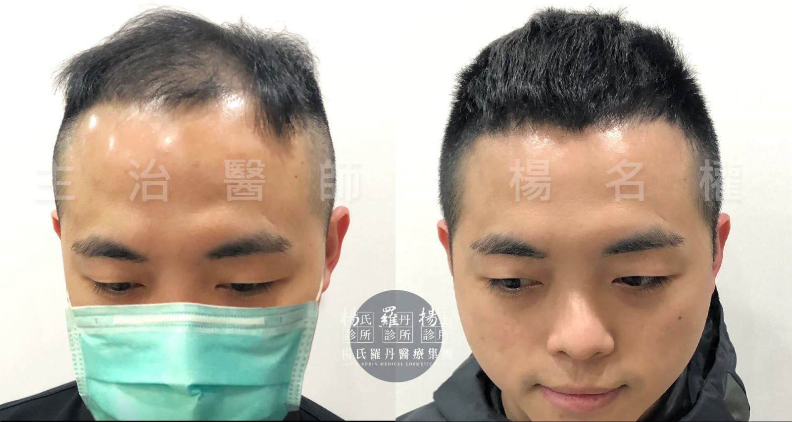 生髮 禿頭 六合一三階段雄性禿治療 掉髮 植髮